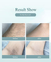 Laser hair removal equipment